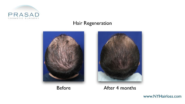 male hair thinning before and after hair regeneration
