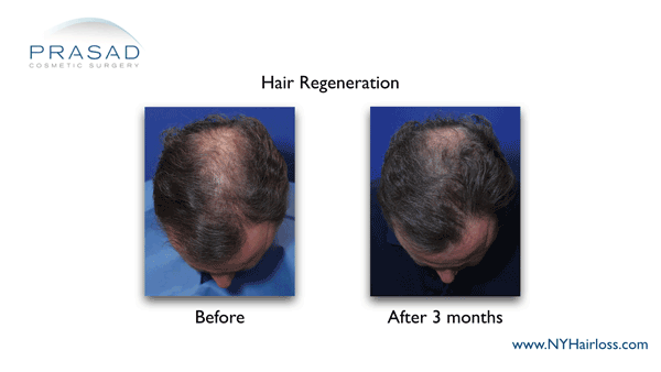 male pattern hairloss 3 months after hair regeneration