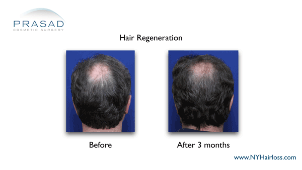 male pattern hairloss 3 months after hair regeneration