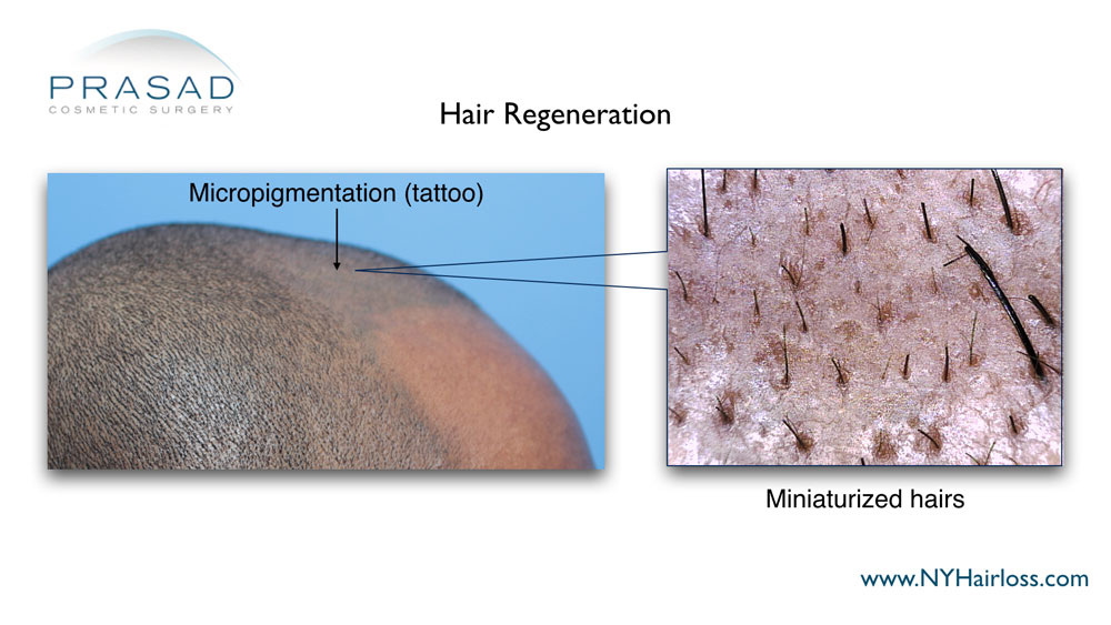 hair loss continuing after scalp micropigmentation