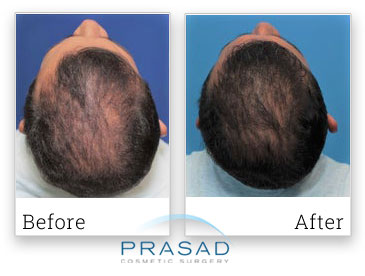 non-surgical hair loss solution photo review before and after