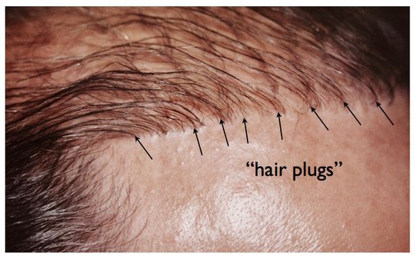 Hair Transplant Limitations | NY Hair Loss
