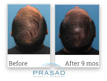 before and 9 months new york prp for hair loss review