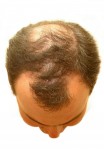 top of man's head with thinning hair