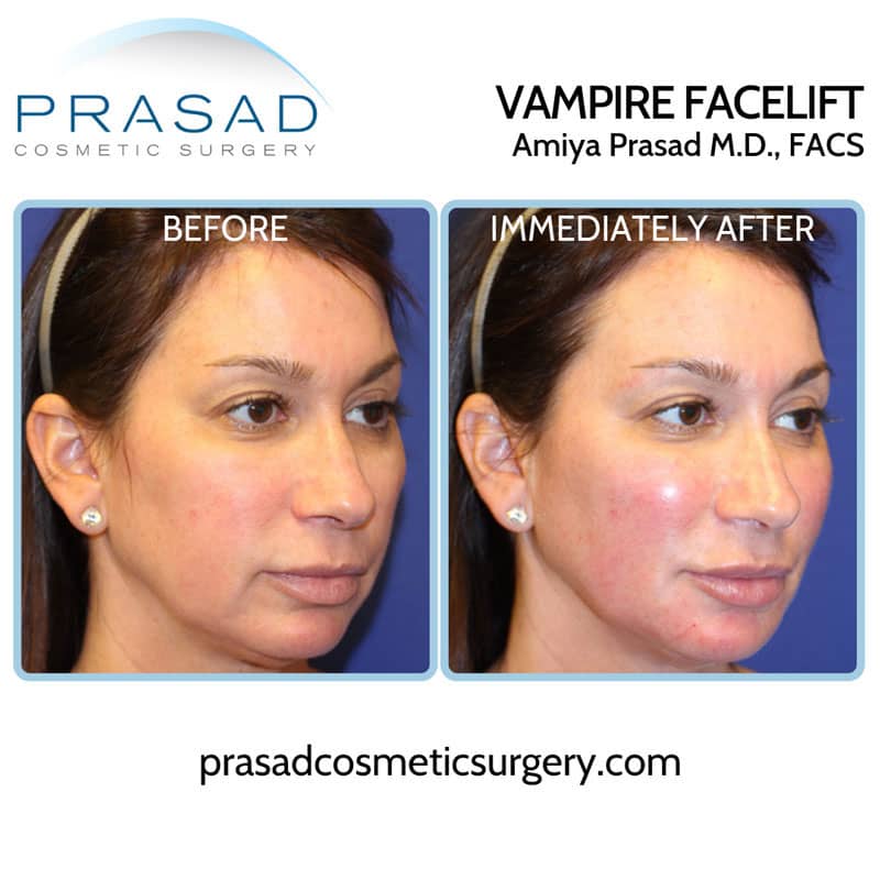 vampire facelift before and immediately after
